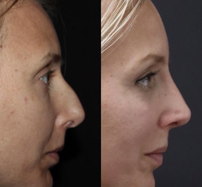 Before & After Rhinoplasty Case 106 Right Side View in Charleston, SC