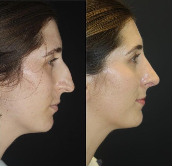 Before & After Rhinoplasty Case 107 Right Side View in Charleston, SC