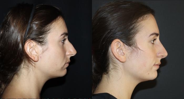 Before & After Rhinoplasty Case 112 Right Side View in Charleston, SC