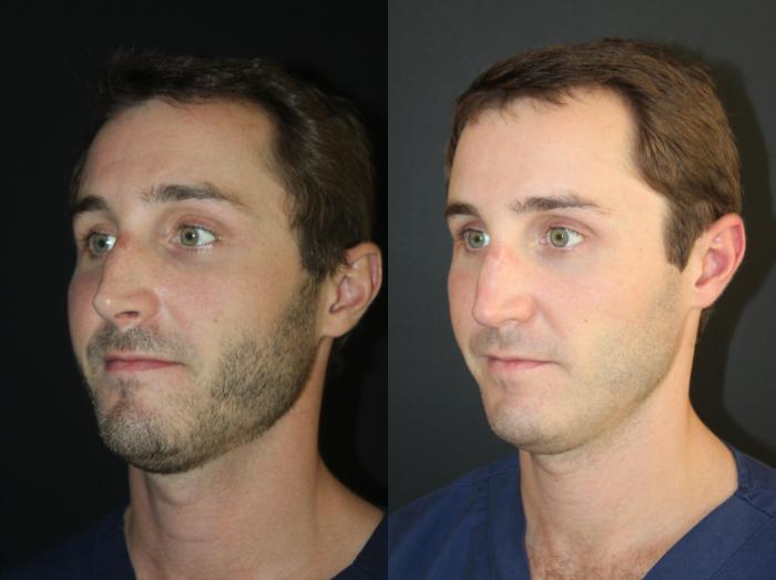 Before & After Rhinoplasty Case 156 Left Oblique View in Charleston, SC