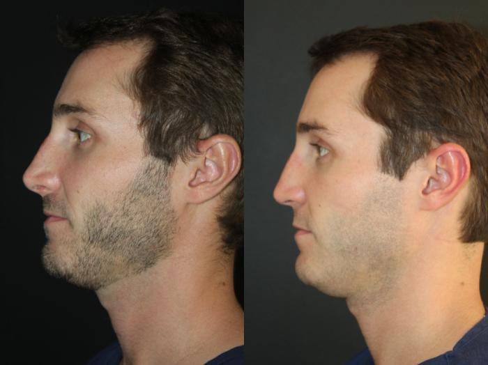 Before & After Rhinoplasty Case 156 Left Side View in Charleston, SC