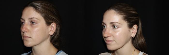 Before & After Rhinoplasty Case 157 Left Oblique View in Charleston, SC