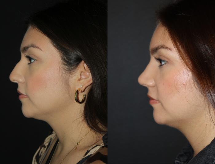 Before & After Rhinoplasty Case 158 Left Side View in Charleston, SC