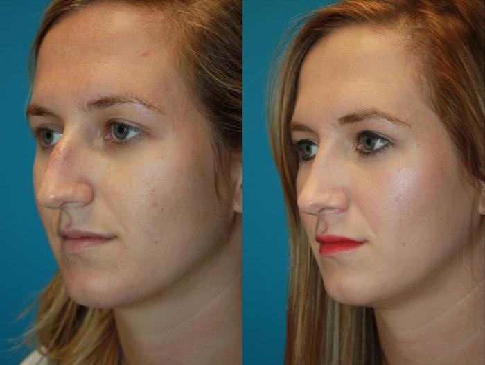 Before & After Rhinoplasty Case 6 Left Oblique View in Charleston, SC