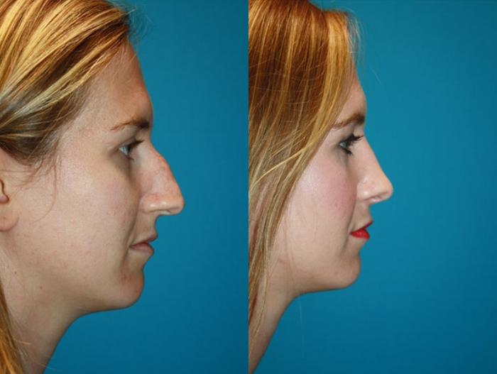 Before & After Rhinoplasty Case 6 Right Side View in Charleston, SC