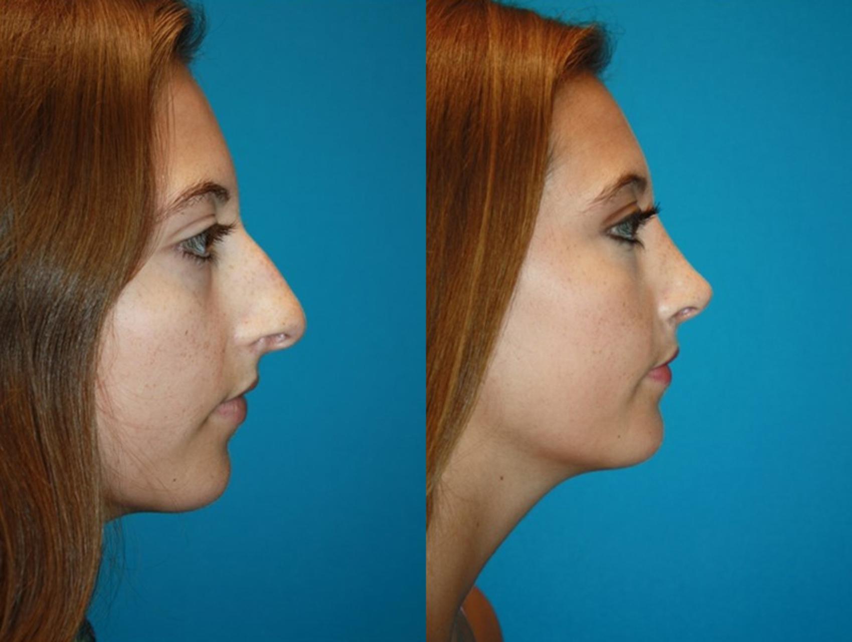Before & After Rhinoplasty Case 77 Right Side View in Charleston, SC