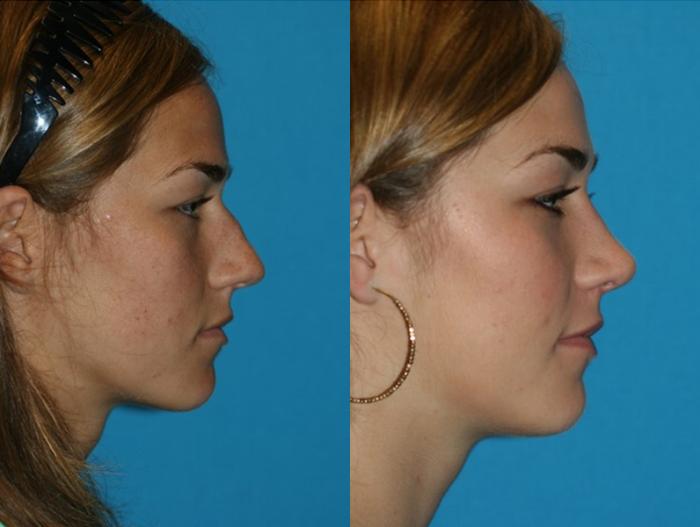 Before & After Rhinoplasty Case 79 Right Side View in Charleston, SC