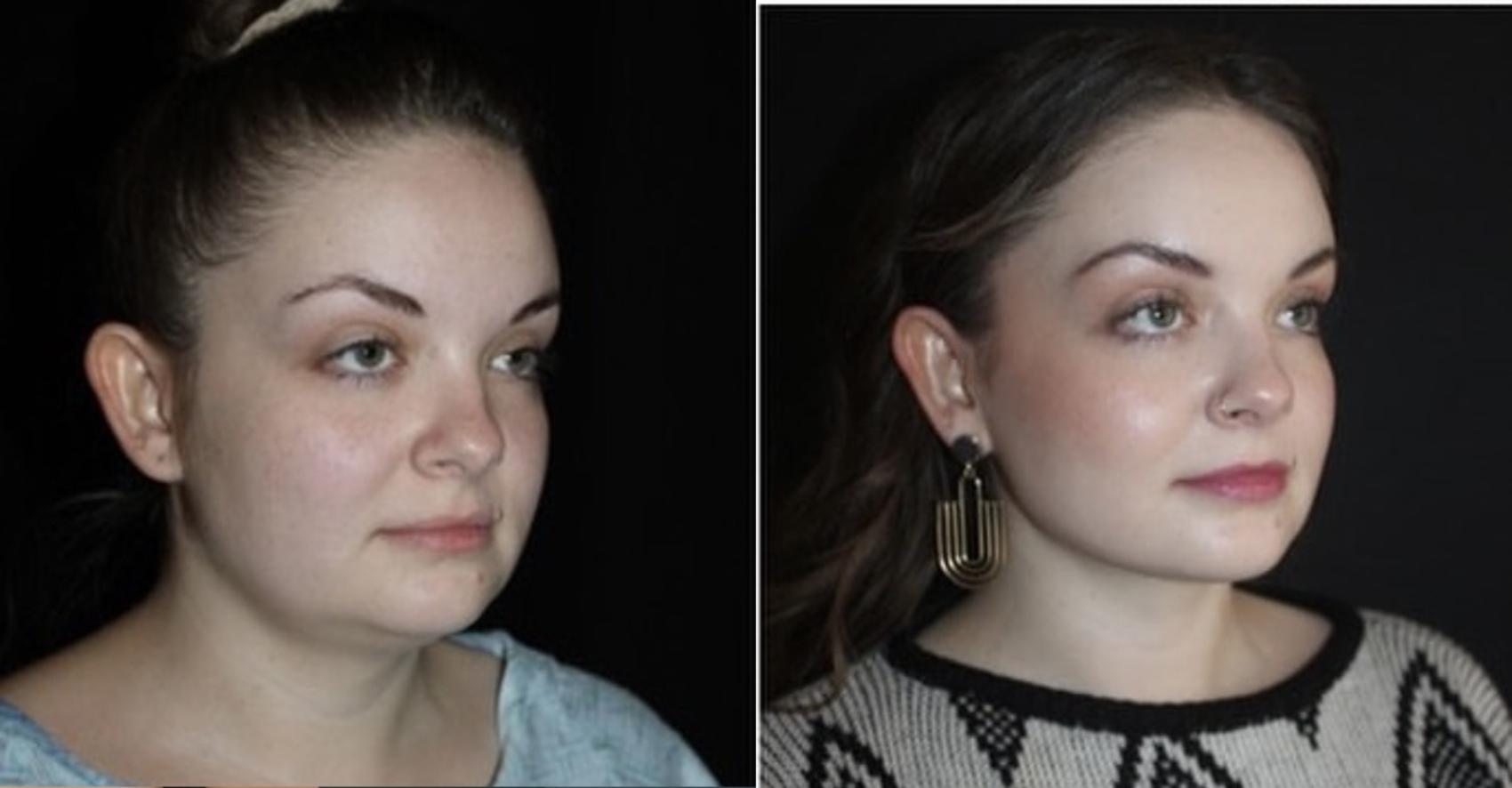 Before & After Submental Liposuction Case 108 Right Oblique View in Charleston, SC