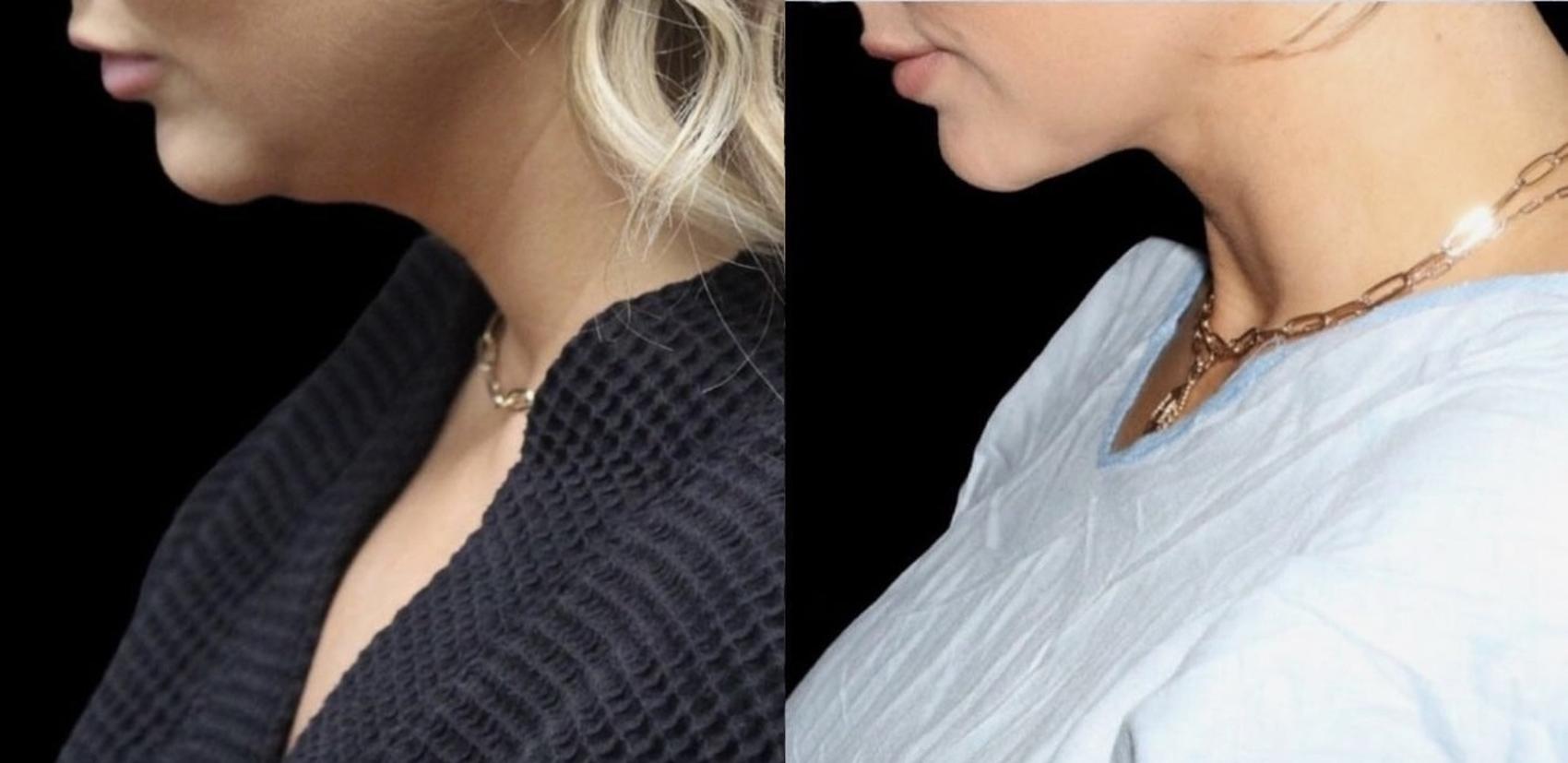 Before & After Submental Liposuction Case 109 Left Side View in Charleston, SC