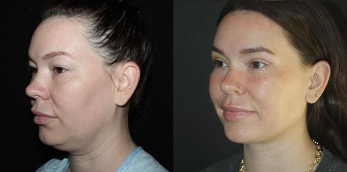 Before & After Submental Liposuction Case 127 Left Oblique View in Charleston, SC