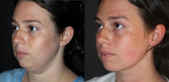 Before & After Submental Liposuction Case 129 Left Oblique View in Charleston, SC