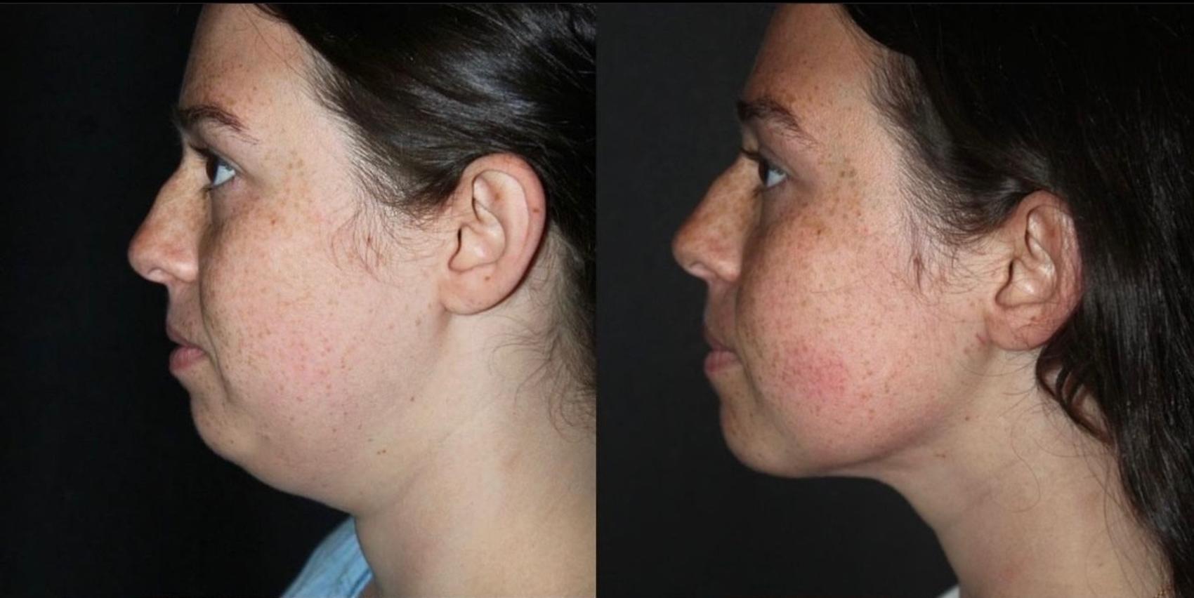 Before & After Submental Liposuction Case 129 Left Side View in Charleston, SC