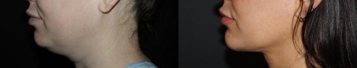 Before & After Submental Liposuction Case 134 Left Side - 1 Year Post-Op View in Charleston, SC