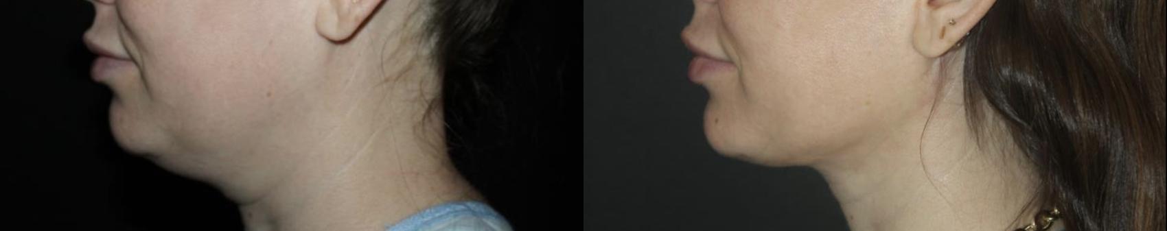 Before & After Submental Liposuction Case 134 Left Side View in Charleston, SC