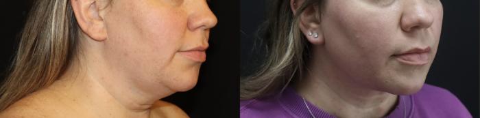 Before & After Submental Liposuction Case 143 Right Oblique View in Charleston, SC