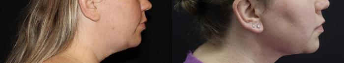 Before & After Submental Liposuction Case 143 Right Side View in Charleston, SC