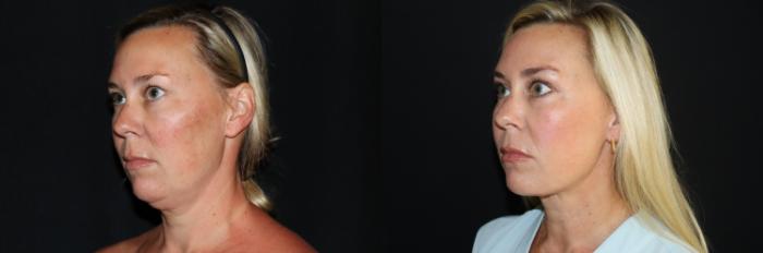 Before & After Submental Liposuction Case 144 Left Oblique View in Charleston, SC