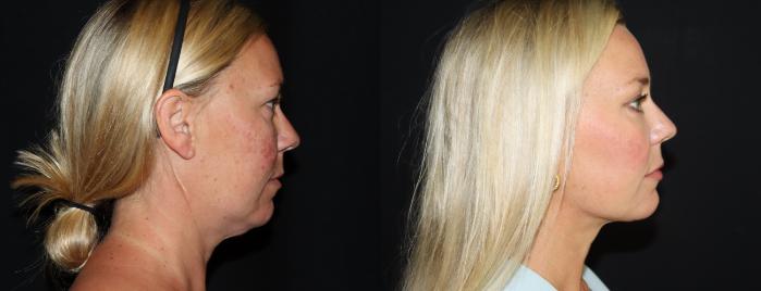 Before & After Submental Liposuction Case 144 Right Side View in Charleston, SC