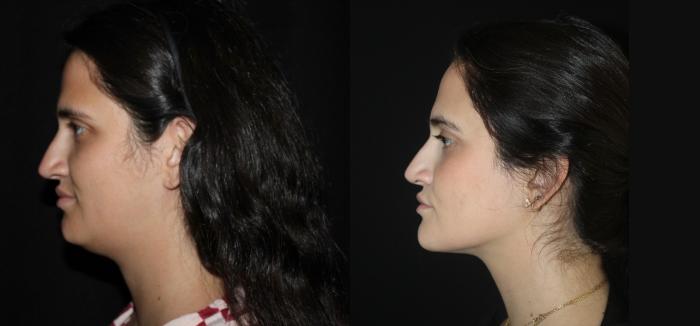 Before & After Submental Liposuction Case 145 Left Side View in Charleston, SC