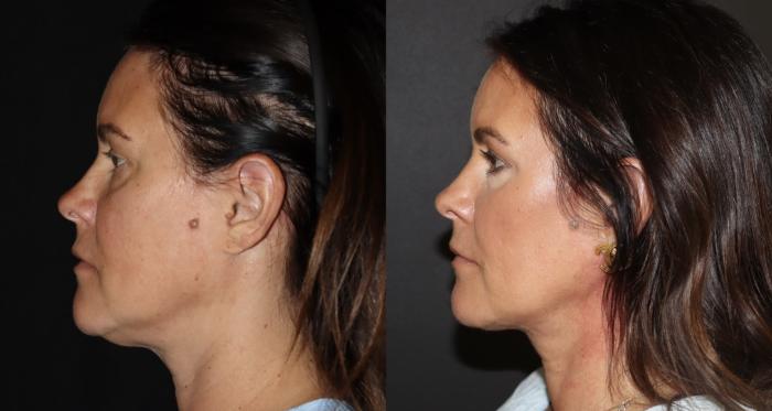 Before & After Submental Liposuction Case 146 Left Side View in Charleston, SC