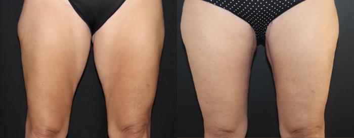 Before & After Thigh LIft Case 159 Front View in Charleston, SC