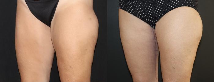 Before & After Thigh LIft Case 159 Left Oblique View in Charleston, SC