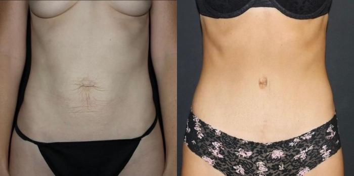 Before & After Tummy Tuck Case 128 Front View in Charleston, SC