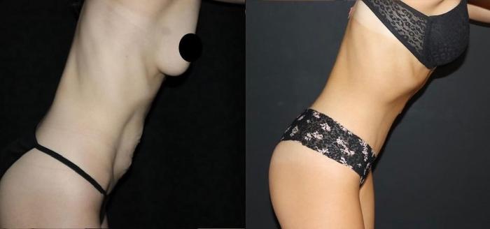 Before & After Tummy Tuck Case 128 Right Side View in Charleston, SC