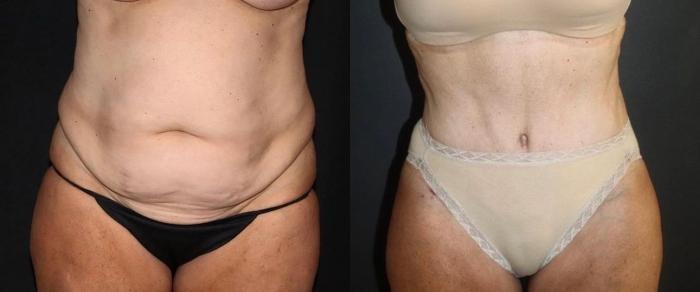 Before & After Tummy Tuck Case 130 Front View in Charleston, SC