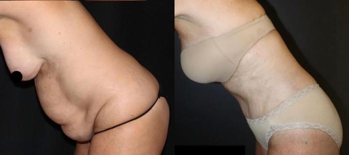Before & After Tummy Tuck Case 130 Right Side View in Charleston, SC