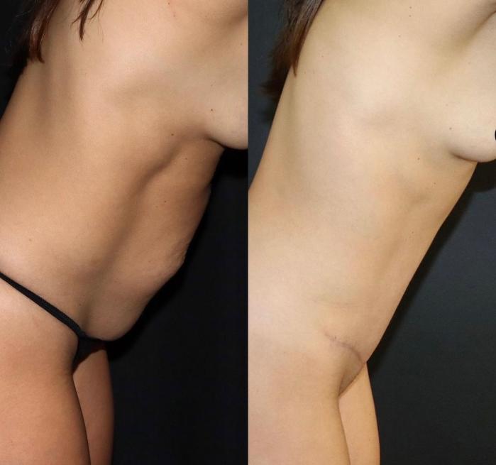 Before & After Tummy Tuck Case 131 Right Side View in Charleston, SC
