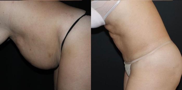 Before & After Tummy Tuck Case 132 Left Side - Leaning Forward View in Charleston, SC