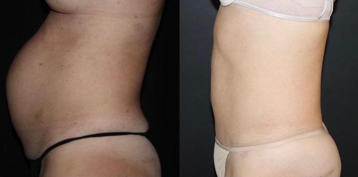 Before & After Tummy Tuck Case 132 Left Side View in Charleston, SC
