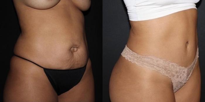 Before & After Tummy Tuck Case 133 Right Oblique View in Charleston, SC