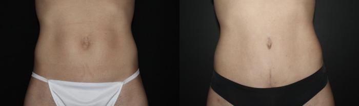 Before & After Tummy Tuck Case 139 Front View in Charleston, SC