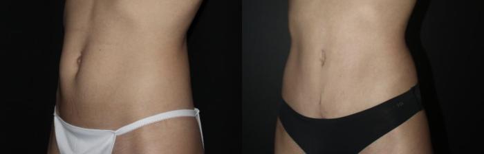 Before & After Tummy Tuck Case 139 Left Oblique View in Charleston, SC
