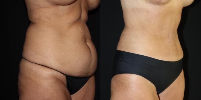 Before & After Tummy Tuck Case 161 Right Oblique View in Charleston, SC