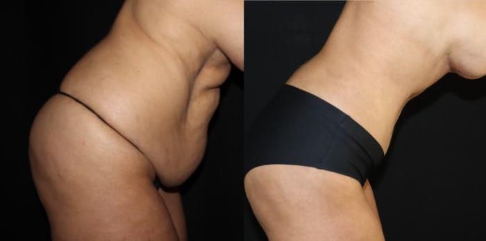 Before & After Tummy Tuck Case 161 Right Side View in Charleston, SC