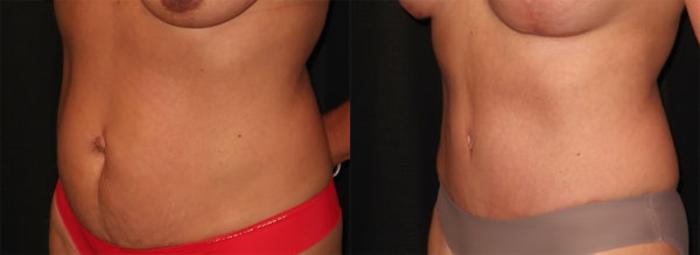 Before & After Tummy Tuck Case 30 Left Oblique View in Charleston, SC