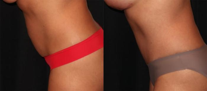 Before & After Tummy Tuck Case 30 Left Side Bending View in Charleston, SC