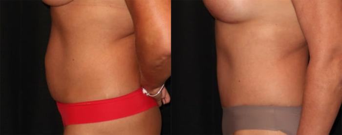 Before & After Tummy Tuck Case 30 Left Side View in Charleston, SC
