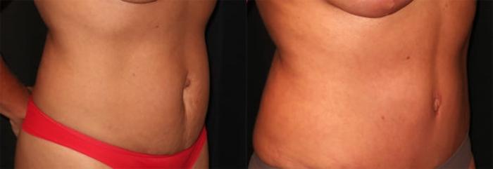 Before & After Tummy Tuck Case 30 Right Oblique View in Charleston, SC