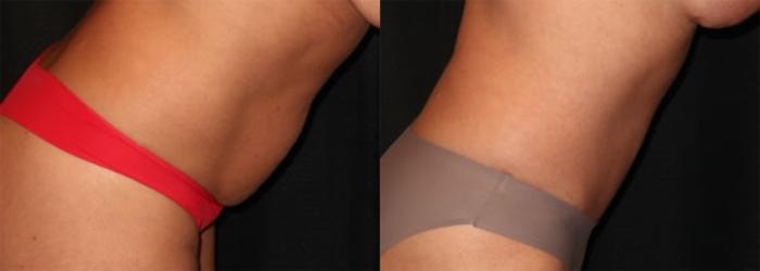 Before & After Tummy Tuck Case 30 Right Side Bending View in Charleston, SC