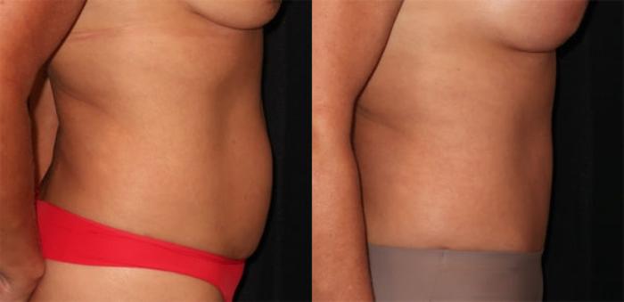 Before & After Tummy Tuck Case 30 Right Side View in Charleston, SC