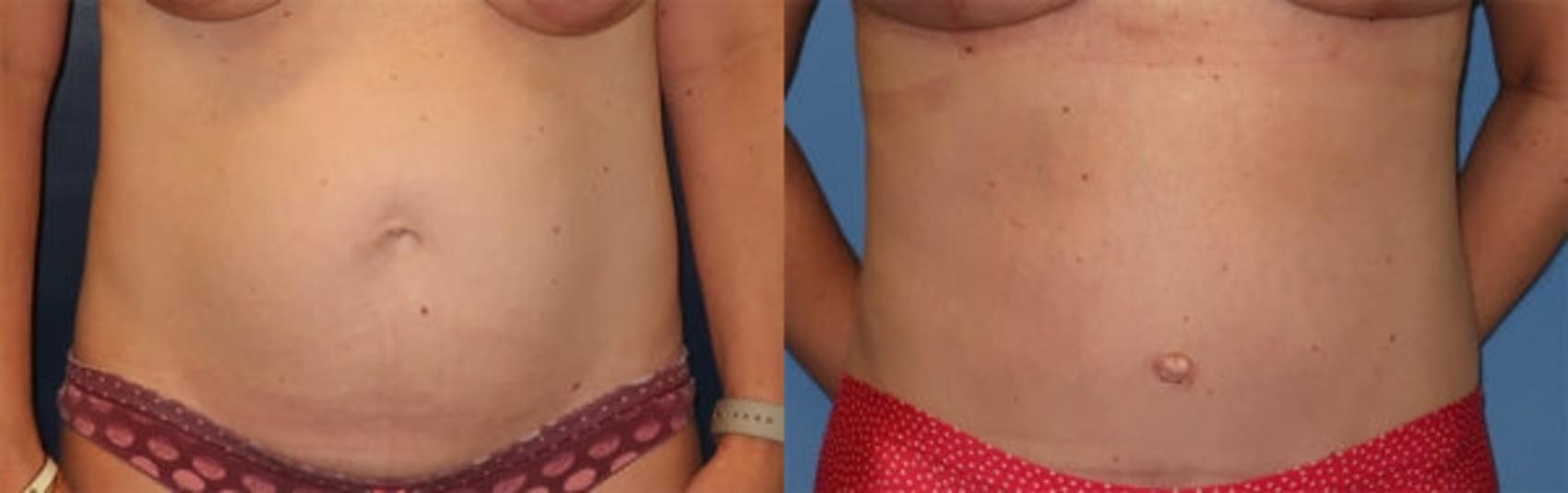 Before & After Tummy Tuck Case 31 Front View in Charleston, SC