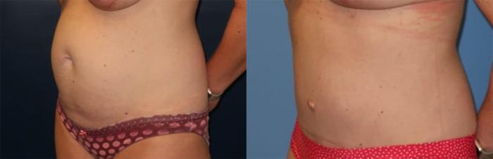 Before & After Tummy Tuck Case 31 Left Oblique View in Charleston, SC