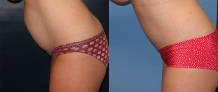 Before & After Tummy Tuck Case 31 Left Side Bending View in Charleston, SC