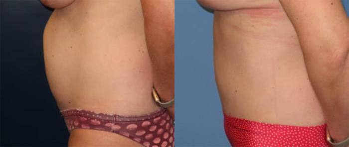Before & After Tummy Tuck Case 31 Left Side View in Charleston, SC