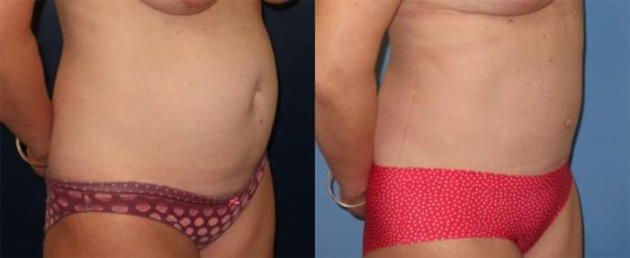 Before & After Tummy Tuck Case 31 Right Oblique View in Charleston, SC