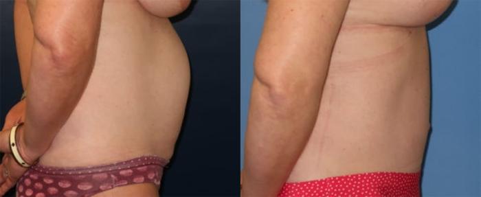 Before & After Tummy Tuck Case 31 Right Side View in Charleston, SC
